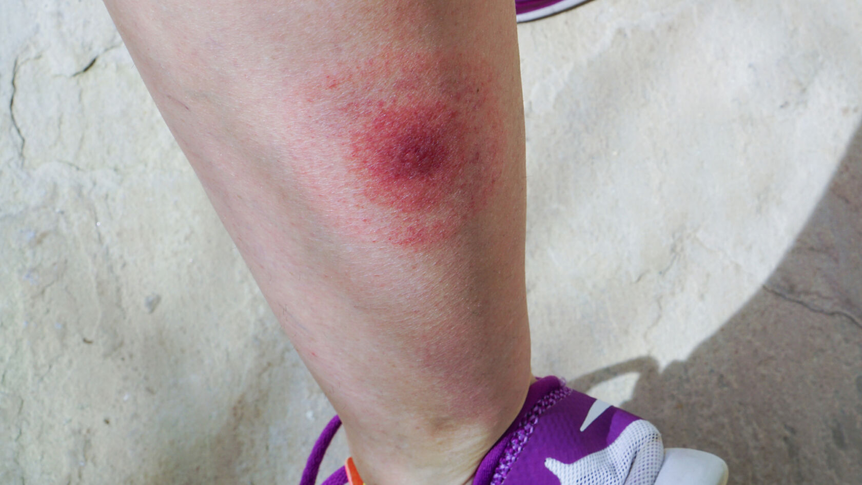 Wat doe je bij een tekenbeet?