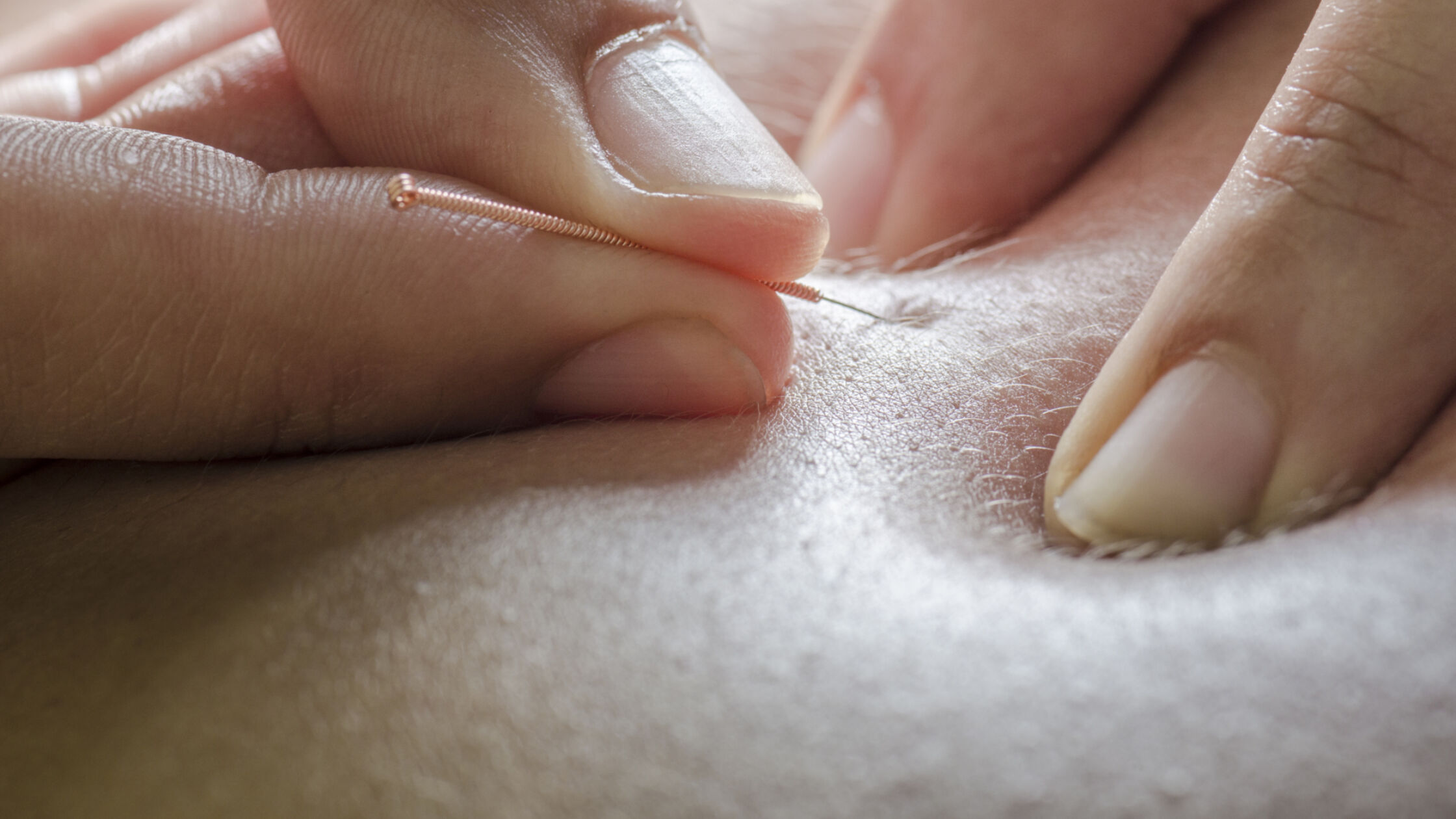 Wat is dry needling?
