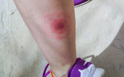 Wat doe je bij een tekenbeet?